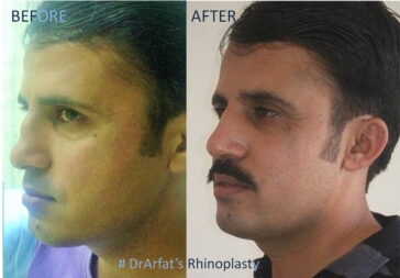 Rhinoplasty Before & After Result