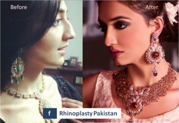 Rhinoplasty Before & After Result