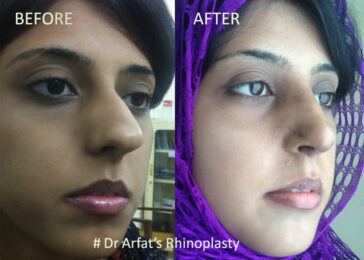 Rhinoplasty Before & After Result