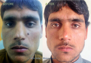 Rhinoplasty Before & After Result