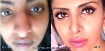 Rhinoplasty Before & After Result