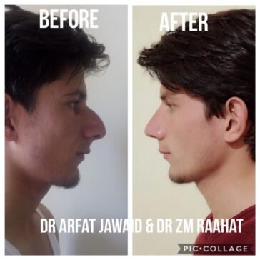 Rhinoplasty Before & After Result