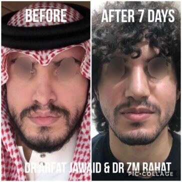 Rhinoplasty Before & After Result