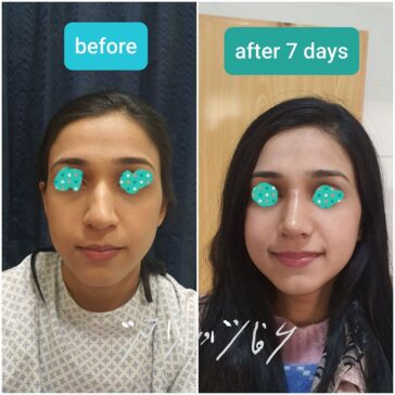 Rhinoplasty Before & After Result
