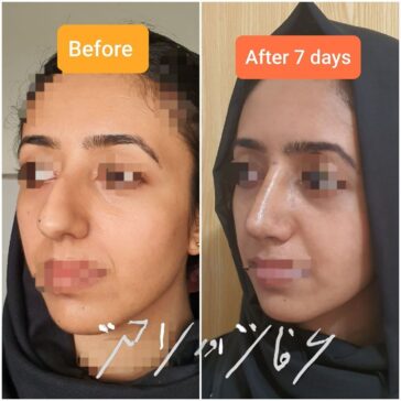 Rhinoplasty Before & After Result