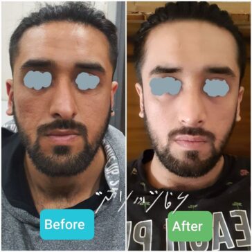 Rhinoplasty Before & After Result