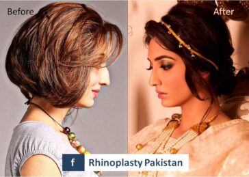 Rhinoplasty Before & After Result