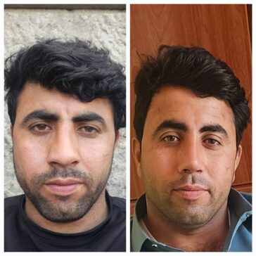 Rhinoplasty Before & After Result