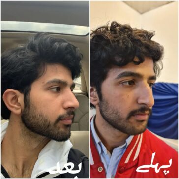 Rhinoplasty Before & After Result