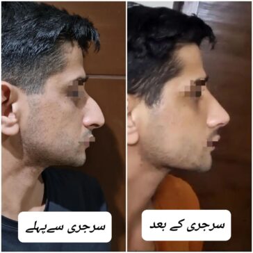 Rhinoplasty Before & After Result
