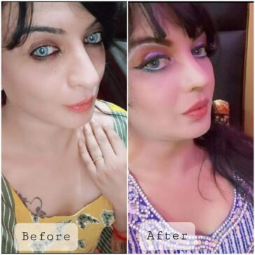 Rhinoplasty Before & After Result