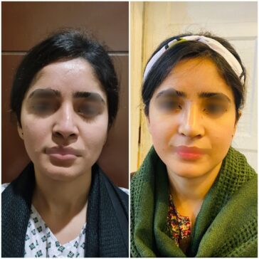 Rhinoplasty Before & After Result