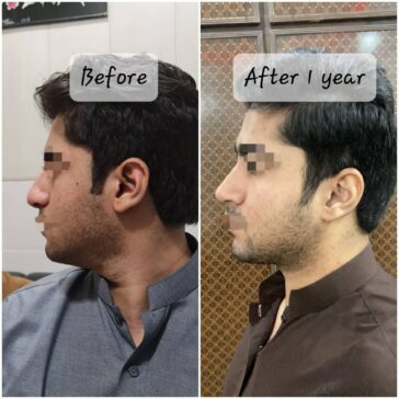 Rhinoplasty Before & After Result