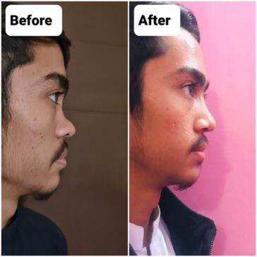 Rhinoplasty Before & After Result