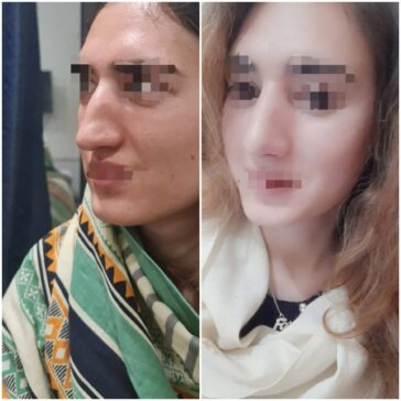 Rhinoplasty Before & After Result