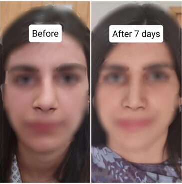 Rhinoplasty Before & After Result