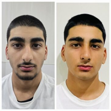 Rhinoplasty Before & After Result