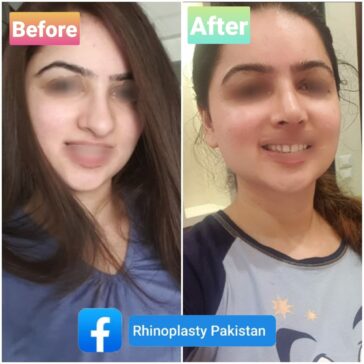Rhinoplasty Before & After Result