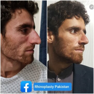 Rhinoplasty Before & After Result