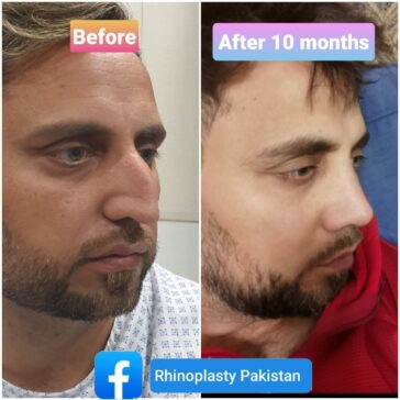 Rhinoplasty Before & After Result