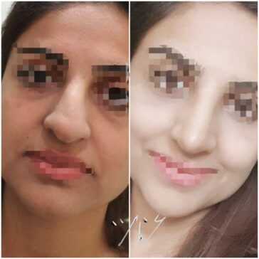 Rhinoplasty Before & After Result