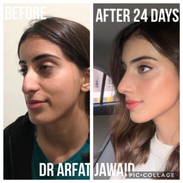 Rhinoplasty Before & After Result