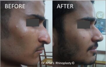 Rhinoplasty Before & After Result