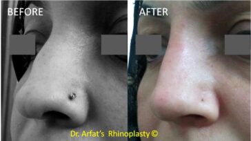 Rhinoplasty Before & After Result