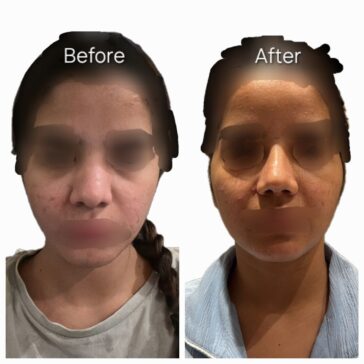Rhinoplasty Before & After Result