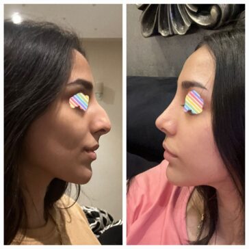 Rhinoplasty Before & After Result
