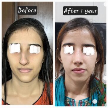 Rhinoplasty Before & After Result