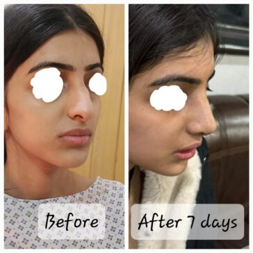 Rhinoplasty Before & After Result
