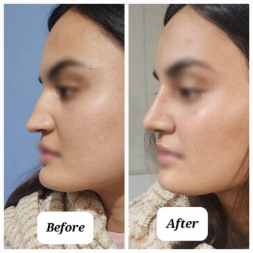Rhinoplasty Before & After Result