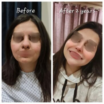 Rhinoplasty Before & After Result