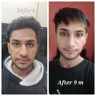 Rhinoplasty Before & After Result